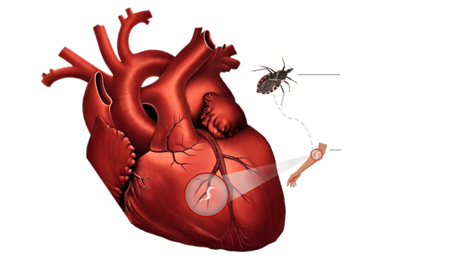 Illustration of a triatomine bug ("kissing bug") transmitting the T. cruzi parasite, which then lives and replicates in heart muscle.